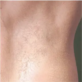 Imagem Antes e depois axila (1-2) - Light Sheer DUET Depilação a laser - Clinical Mobile locações, cursos on-line e presencial, workshop e mentoria estética