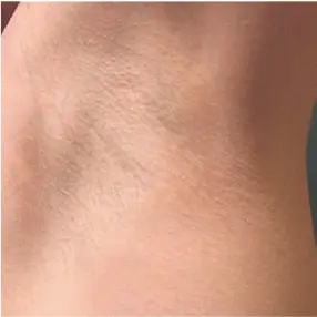 Imagem Antes e depois axila (2-2) - Light Sheer DUET Depilação a laser - Clinical Mobile locações, cursos on-line e presencial, workshop e mentoria estética