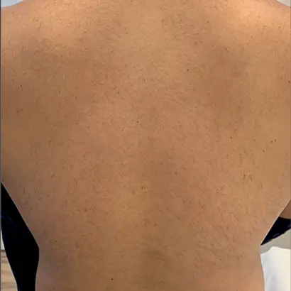 Imagem Antes e depois costa (2-2) - Light Sheer DUET Depilação a laser - Clinical Mobile locações, cursos on-line e presencial, workshop e mentoria estética