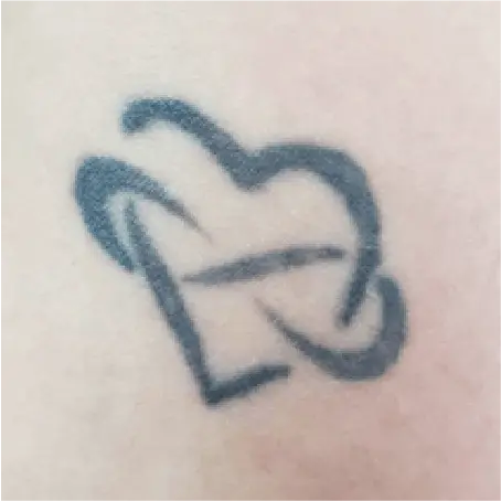 Imagem Resultado Inkie - Modelo 01 (1-2) Inkie laser Q-switched Despigmentação remoção tatuagem - Clinical Mobile locações, cursos on-line e presencial, workshop e mentoria estética