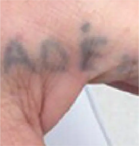 Imagem Resultado Inkie - Modelo 02 (1-2) Inkie laser Q-switched Despigmentação remoção tatuagem - Clinical Mobile locações, cursos on-line e presencial, workshop e mentoria estética