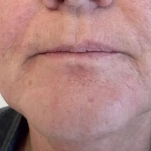 Imagem Resultado 2 (2-2) - Ultraformer 3 Ultrassom Microfocado e macrofocado Medsystems - Clinical Mobile locações, cursos on-line e presencial, workshop e mentoria estética
