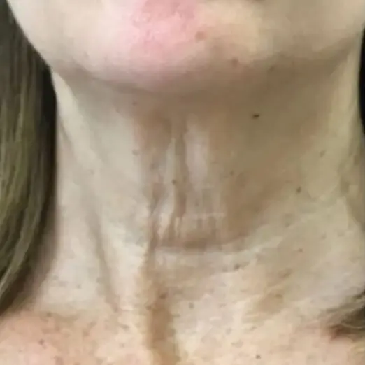 Imagem Resultado 1 (1-2) - Ultraformer 3 Ultrassom Microfocado e macrofocado Medsystems - Clinical Mobile locações, cursos on-line e presencial, workshop e mentoria estética