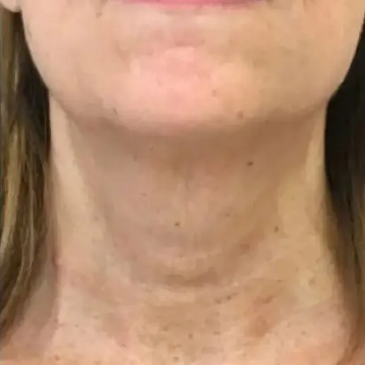 Imagem Resultado 1 (2-2) - Ultraformer 3 Ultrassom Microfocado e macrofocado Medsystems - Clinical Mobile locações, cursos on-line e presencial, workshop e mentoria estética