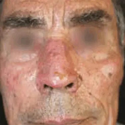 Imagem Resultado Modelo 01 (1-2) - Youlaser MT laser co2 fracionado - Clinical Mobile locações, cursos on-line e presencial, workshop e mentoria estética