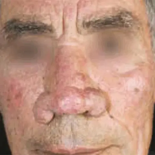 Imagem Resultado Modelo 01 (2-2) - Youlaser MT laser co2 fracionado - Clinical Mobile locações, cursos on-line e presencial, workshop e mentoria estética