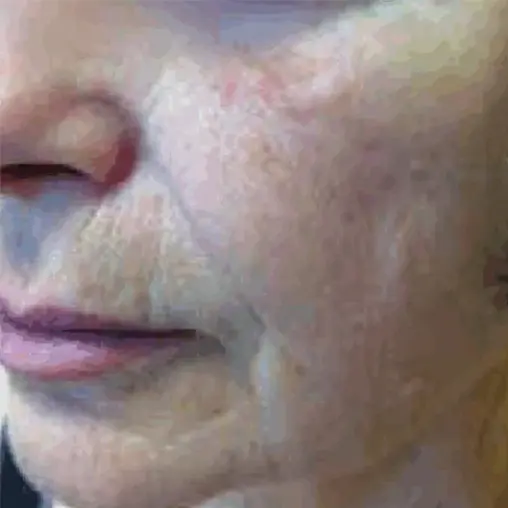 Imagem Resultado Modelo 02 (1-2) - Youlaser MT laser co2 fracionado - Clinical Mobile locações, cursos on-line e presencial, workshop e mentoria estética