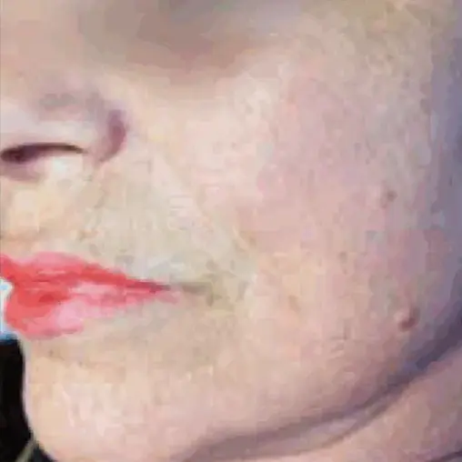 Imagem Resultado Modelo 02 (2-2) - Youlaser MT laser co2 fracionado - Clinical Mobile locações, cursos on-line e presencial, workshop e mentoria estética