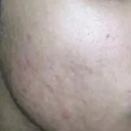 Imagem Resultado Modelo 03 (2-2) - Youlaser MT laser co2 fracionado - Clinical Mobile locações, cursos on-line e presencial, workshop e mentoria estética