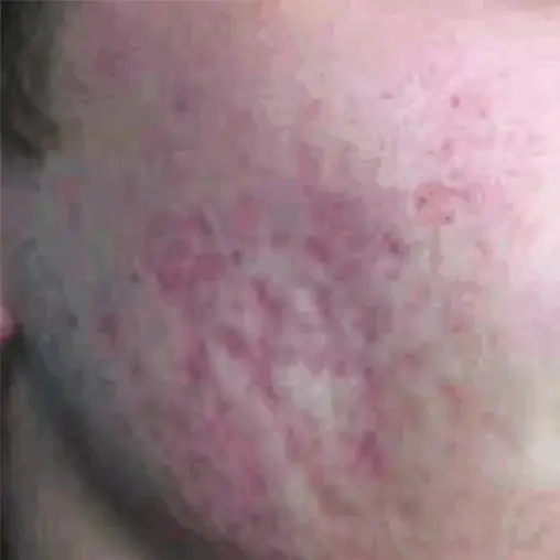 Imagem Resultado Modelo 03 (1-2) - Youlaser MT laser co2 fracionado - Clinical Mobile locações, cursos on-line e presencial, workshop e mentoria estética