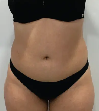 Imagem resultados paciente 1 (1-2) - Artix Criolipólise placa KLD - Clinical Mobile locações, cursos on-line e presencial, workshop e mentoria estética