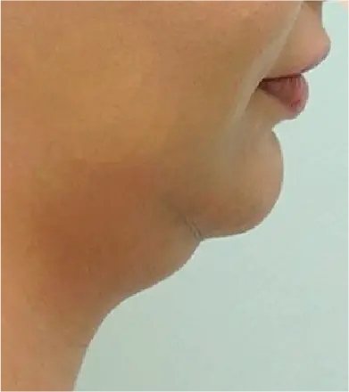 resultados paciente 1 (1-2) - Beauty Shape duo Criolipólise placa e sucção HTM - Clinical Mobile locações, cursos on-line e presencial, workshop e mentoria estética