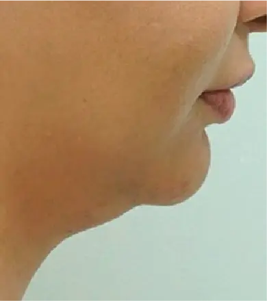 resultados paciente 1 (2-2) - Beauty Shape duo Criolipólise placa e sucção HTM - Clinical Mobile locações, cursos on-line e presencial, workshop e mentoria estética