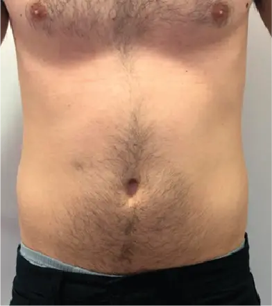 Imagem resultados paciente 2 (1-2) - Artix Criolipólise placa KLD - Clinical Mobile locações, cursos on-line e presencial, workshop e mentoria estética