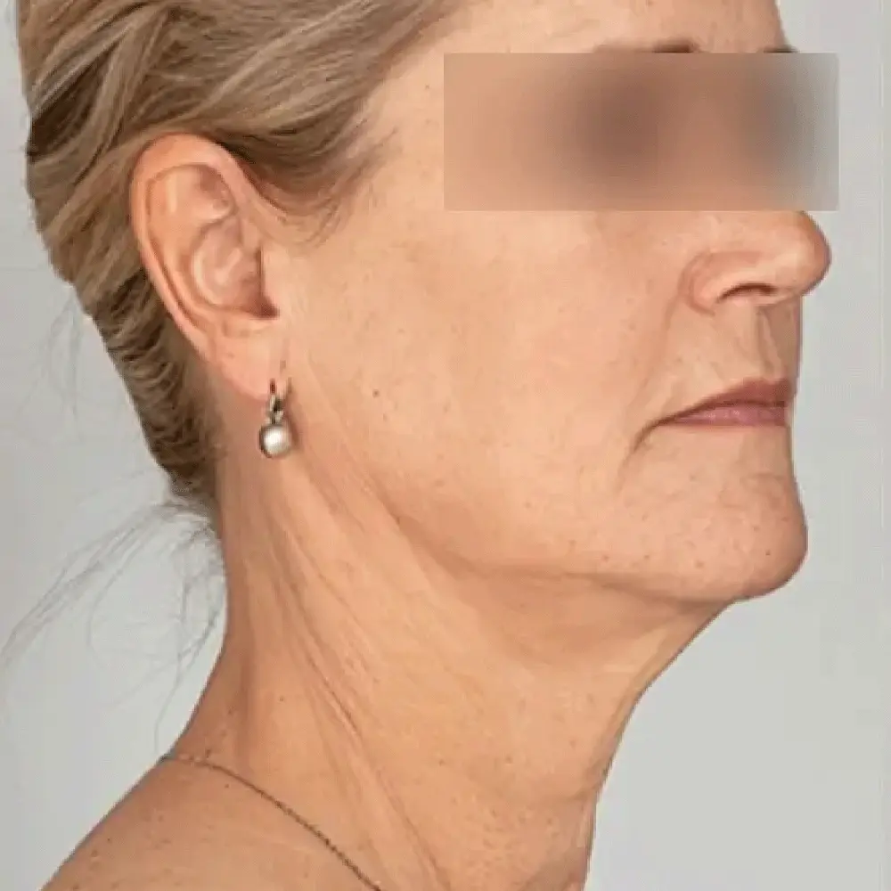 Resultado paciente 1 (1-2) - Equipamento Pioon Endolaser - Clinical Mobile locações, cursos on-line e presencial, workshop e mentoria estética