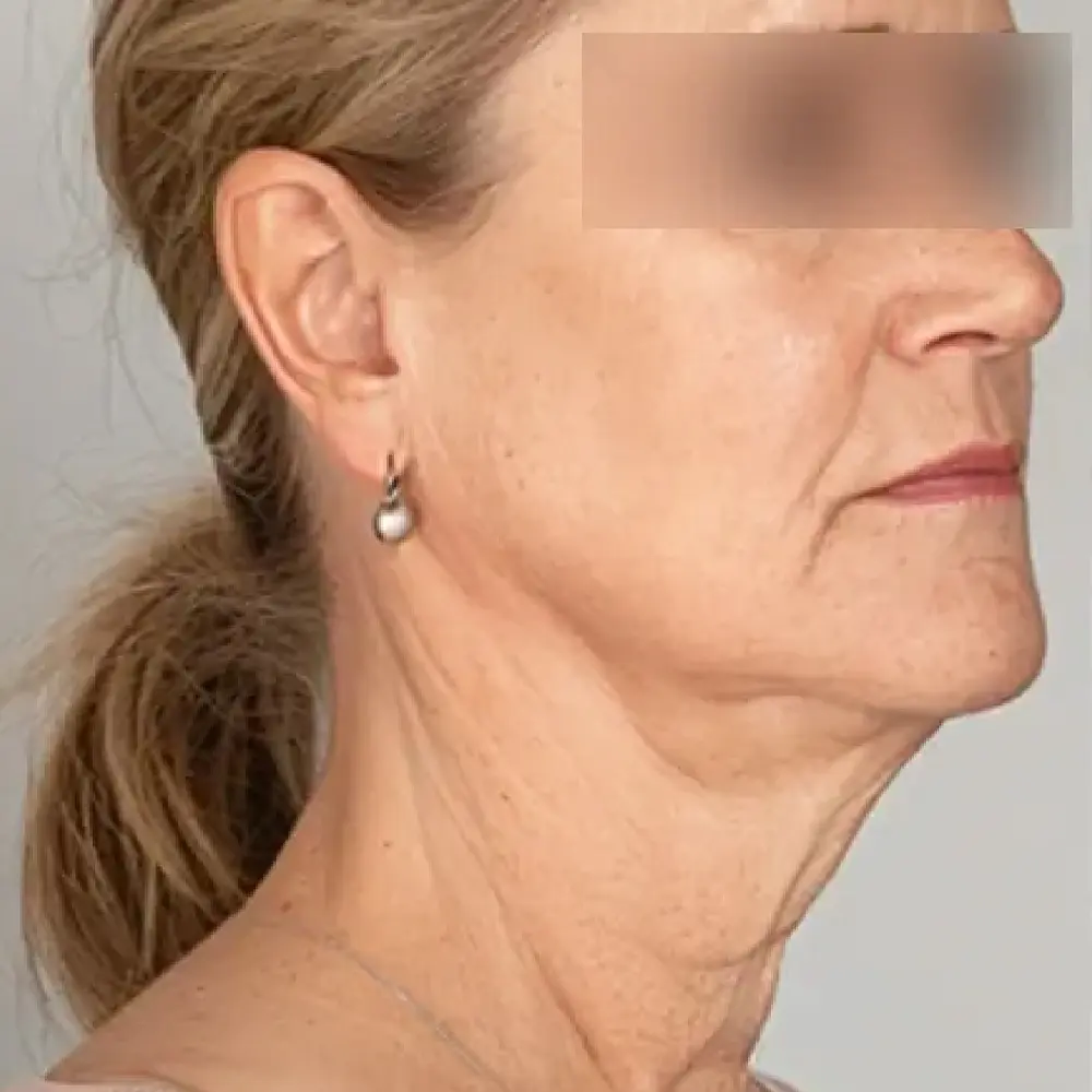 Resultado paciente 1 (2-2) - Equipamento Pioon Endolaser - Clinical Mobile locações, cursos on-line e presencial, workshop e mentoria estética